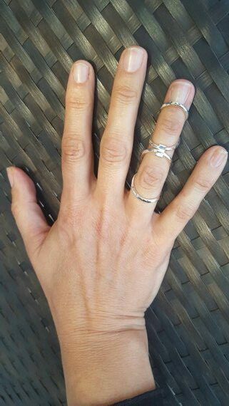 Silver ring splint