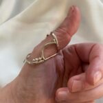 silver ring splint