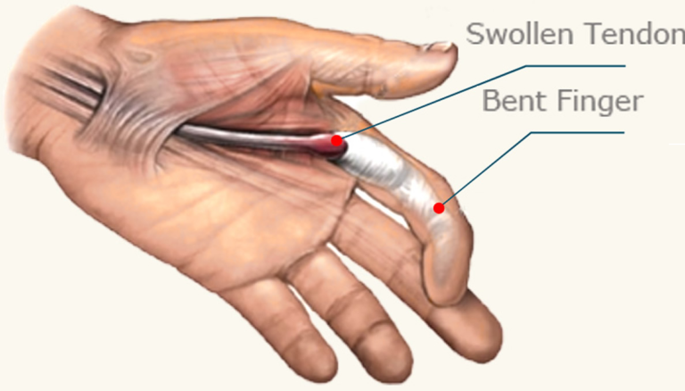 Trigger Finger Splint Rings | JewelSplint