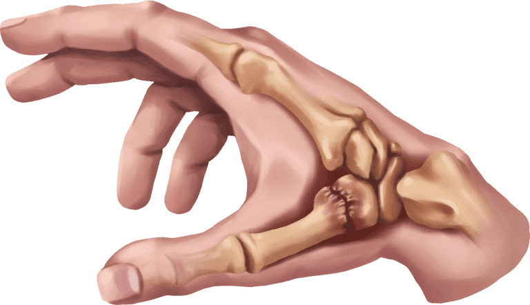 Ring splints for arthritis finges.