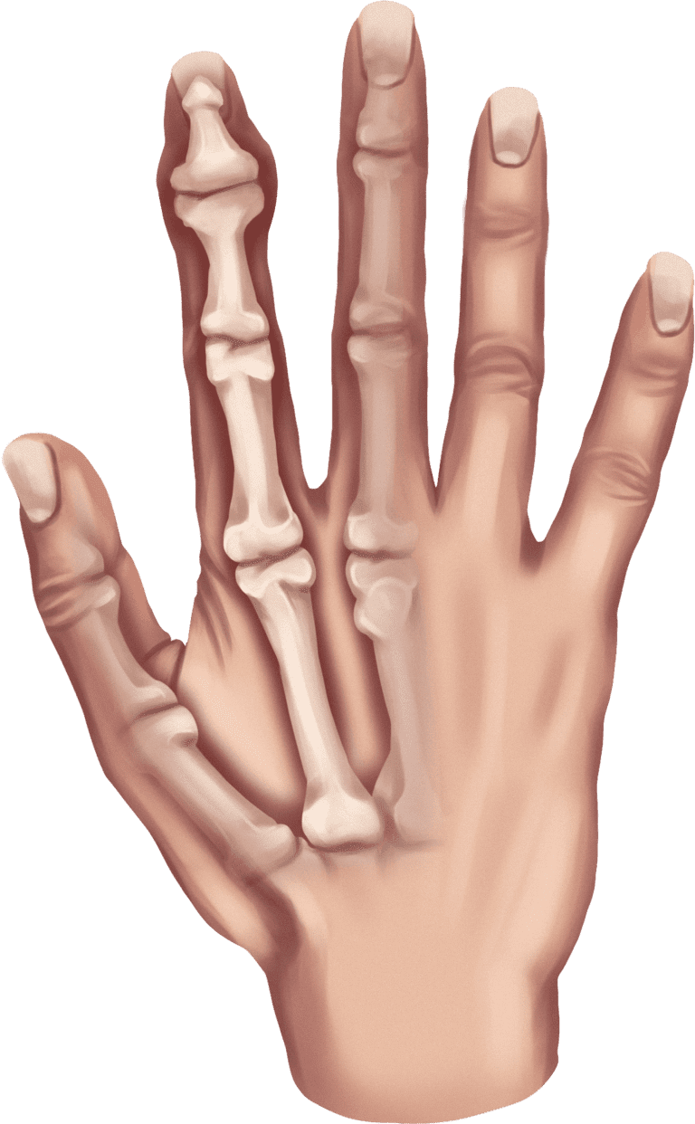 Arthritis Joints Splints