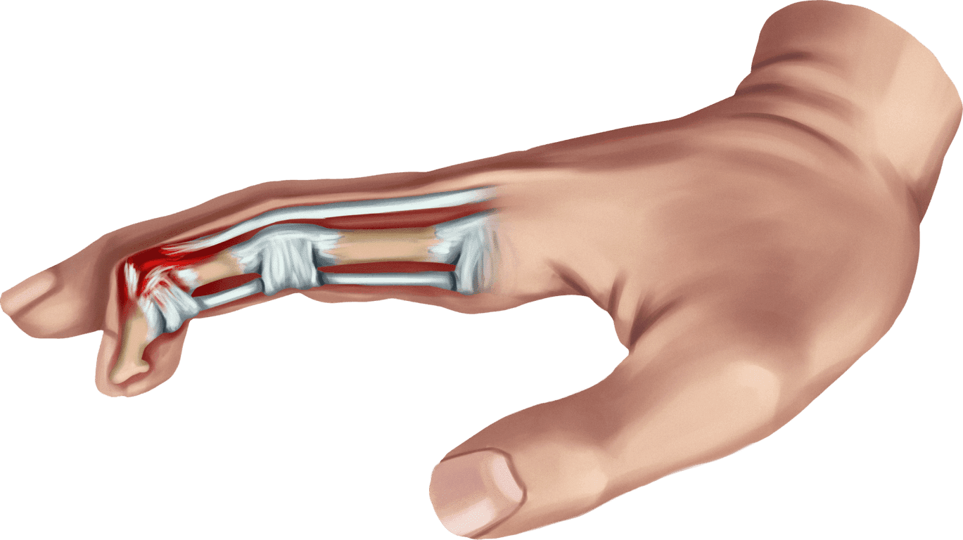 Avoiding Ring Avulsions - ORA Orthopedics