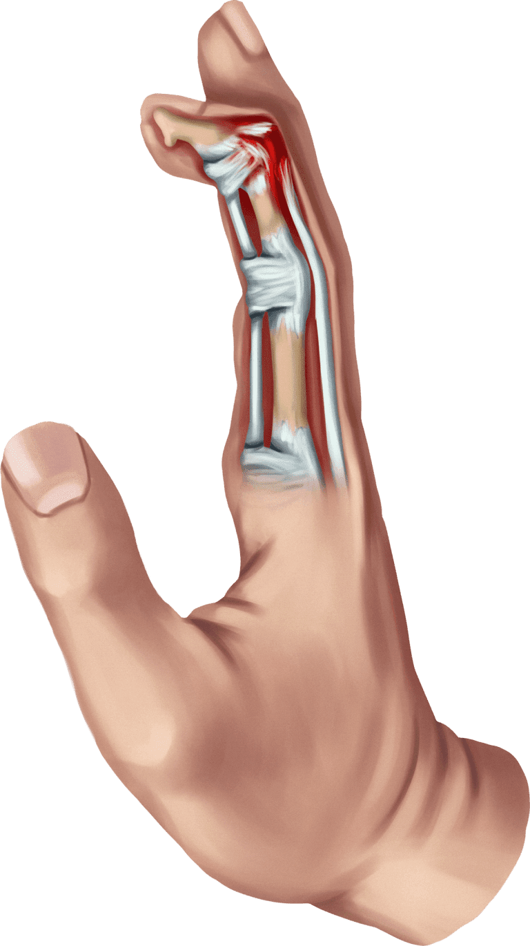 Adjustable PIP OR DIP Splint Ring Sterling Silver Trigger Finger Splint Ring  | eBay