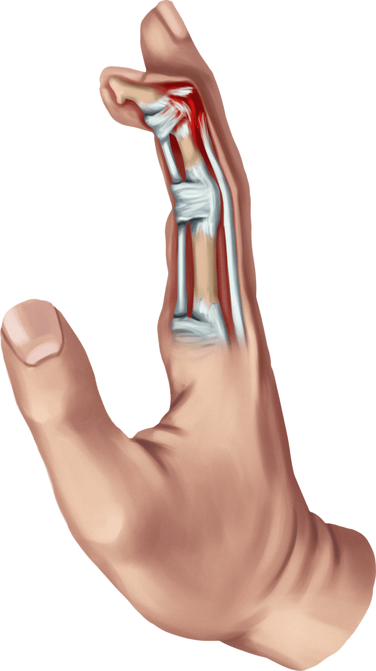 Jewelsplint sales
