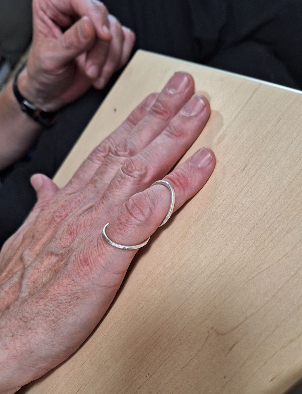 Swan Neck Deformity Managing it with Orthopedic Silver Ring Splints