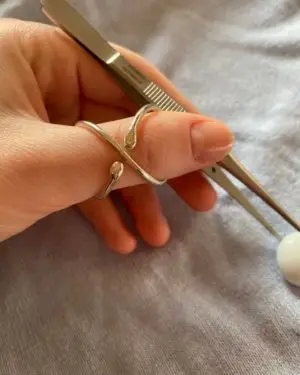 silver ring splint