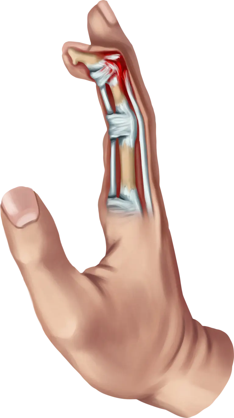 Mallet finger splint
