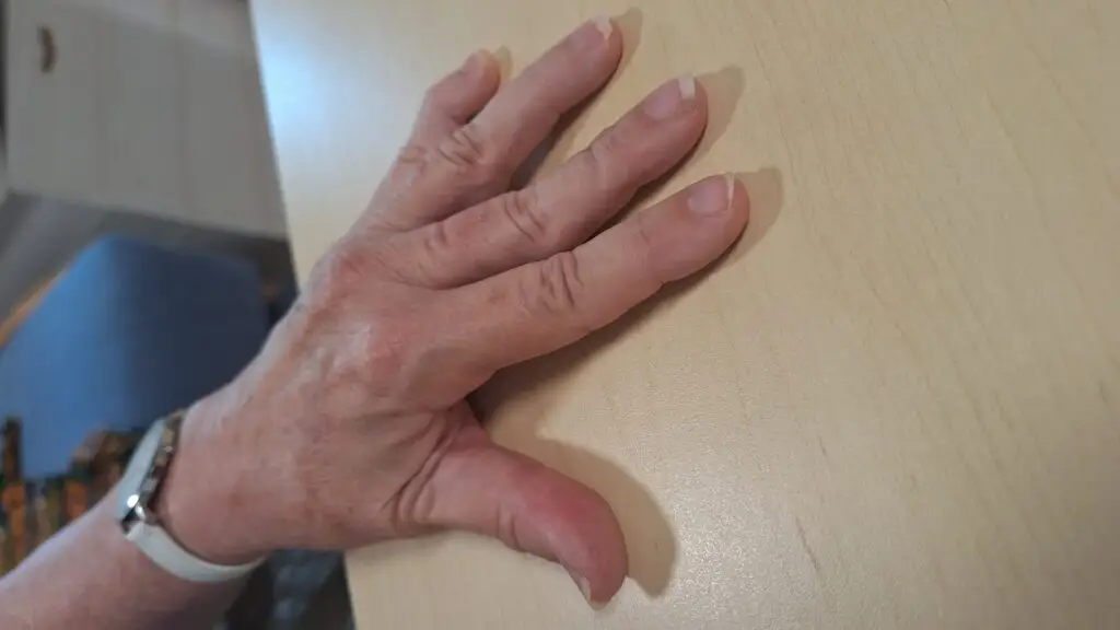 Swan neck finger deformity support